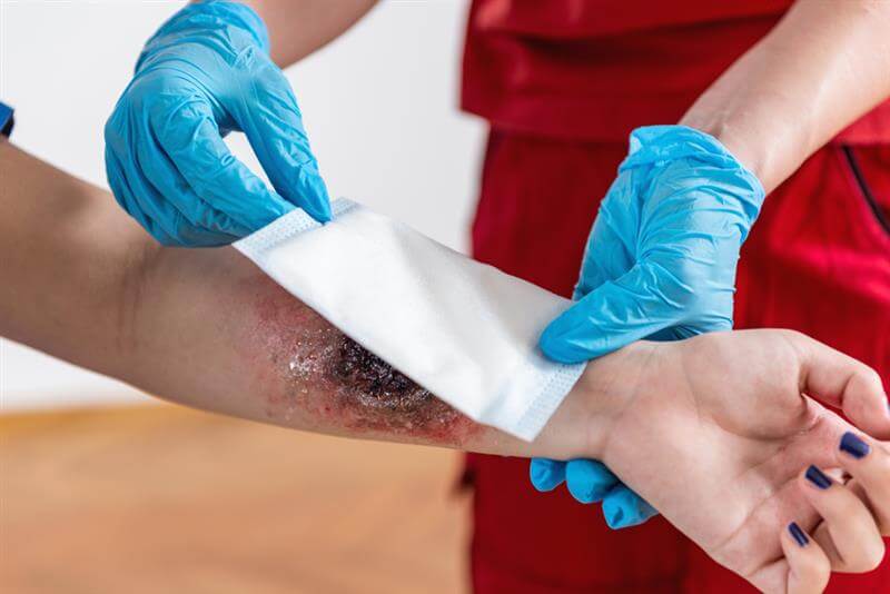 Paramedics treating first aid to burn injury patient.